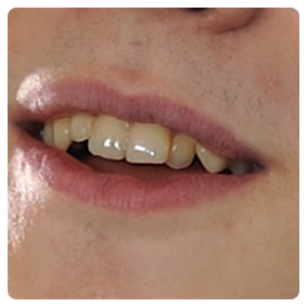 Retusz brakujących zębów